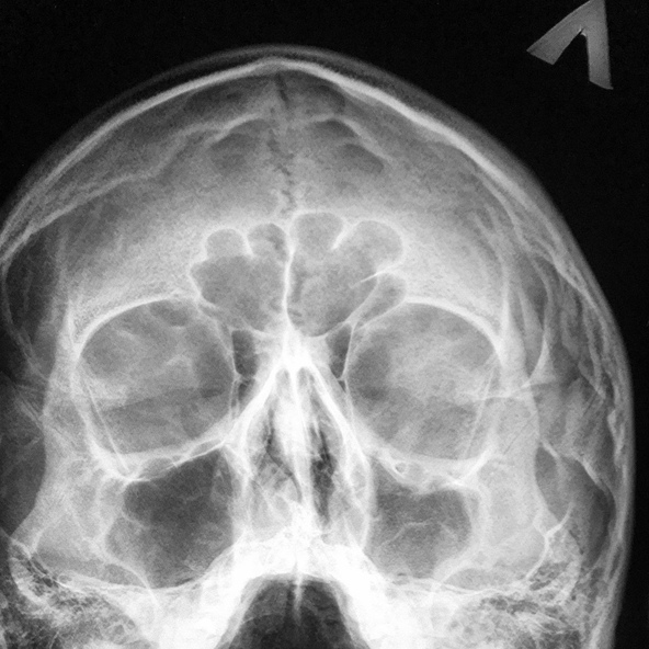 ПУРА — Черная масса